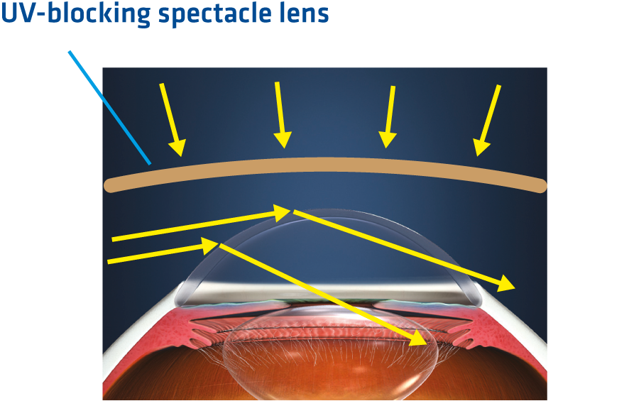 UV-blocking spectacle lens