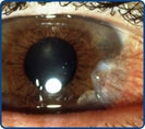 Pterygium